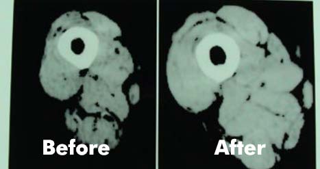 CT Scan of 104 year old woman's leg before and after KAATSU training