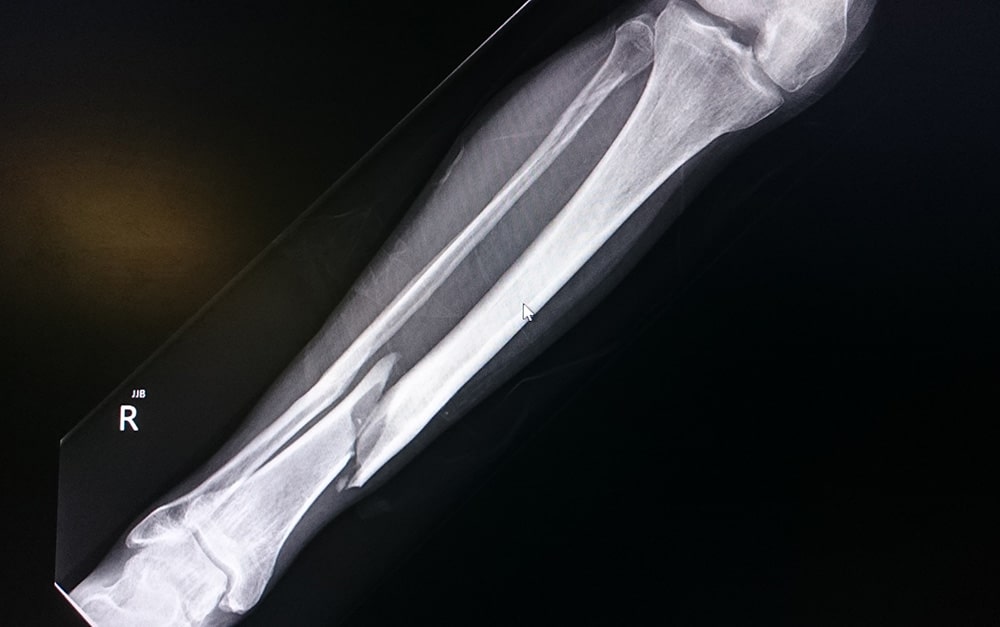 Image of an x-ray showing a broken tibia bone in the leg.