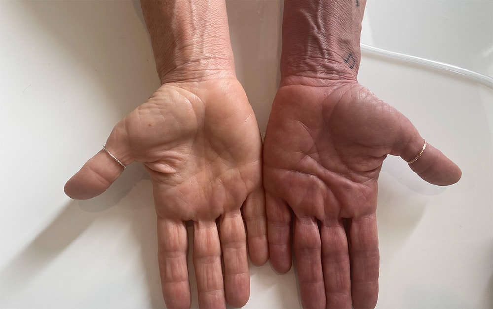 A picture showing two hands, the one on the left with normal colour, and the one on the right with KAATSU colour - darker because of the engorgement of blood in the limb.
