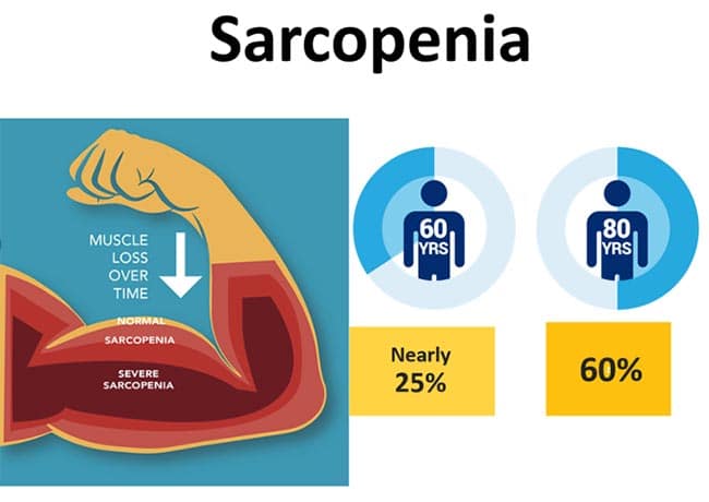 sarcopenia